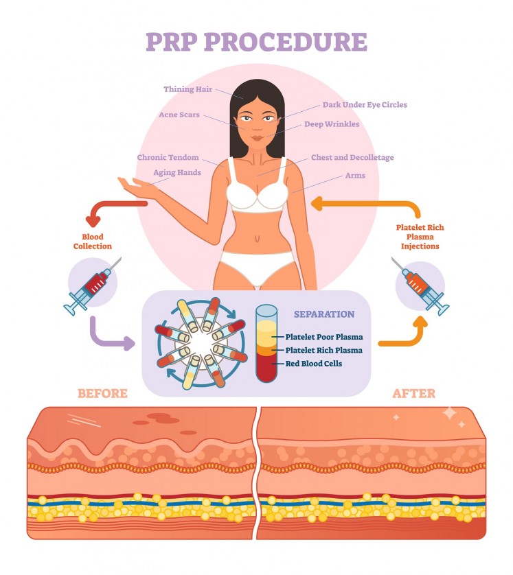 PRP procedure vector illustration 