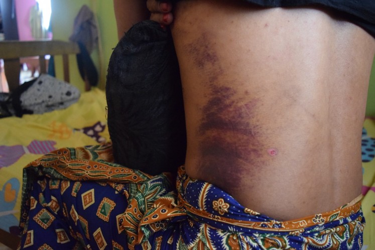A Malaysian transgender woman who suffered physical assault shows injuries on her back during an interview in Rantau, Malaysia on August 20, 2018. THOMSON REUTERS FOUNDATION/ Beh Lih Yi