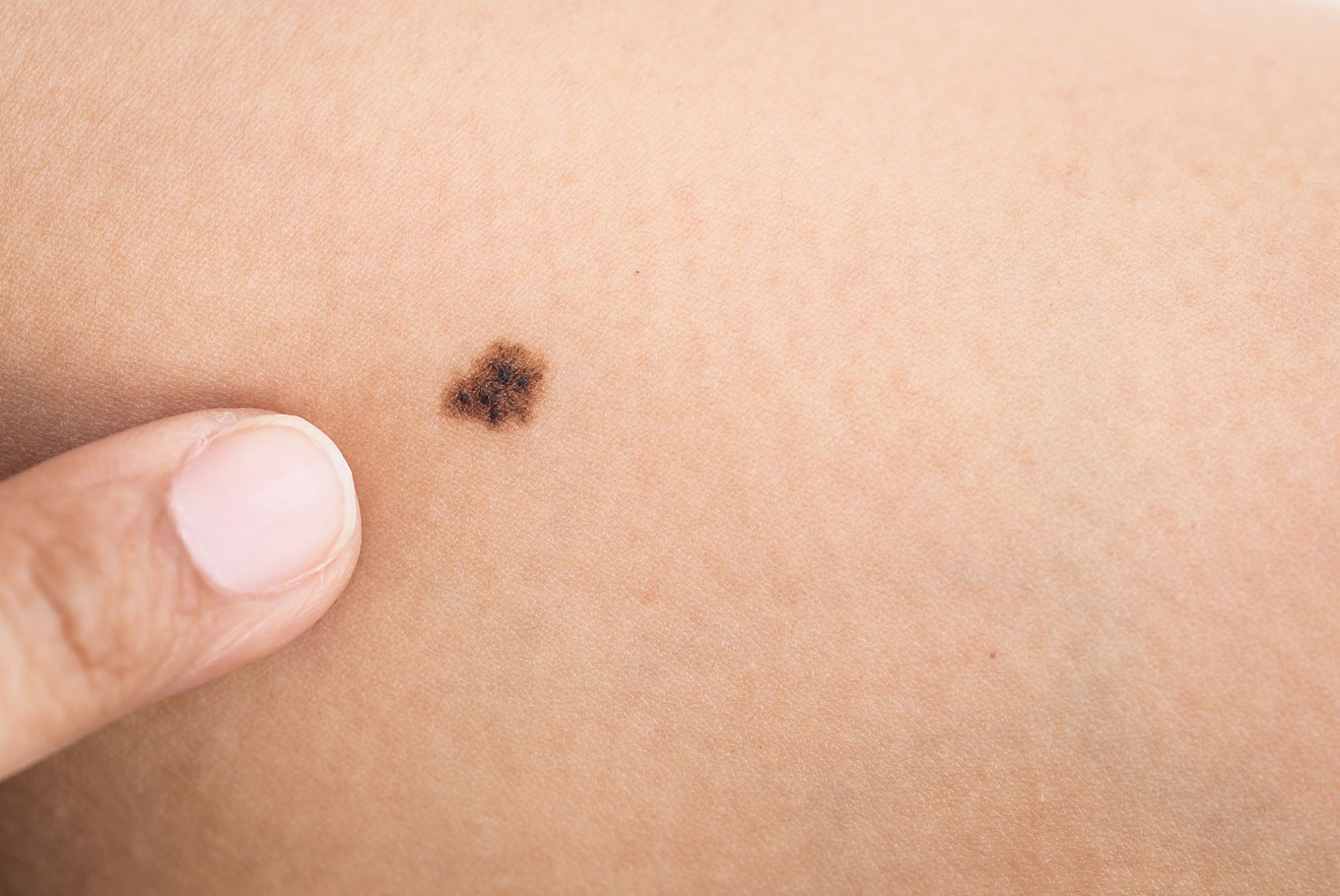 Here&#39;s how to check if your mole is cancerous - Health - The Jakarta Post