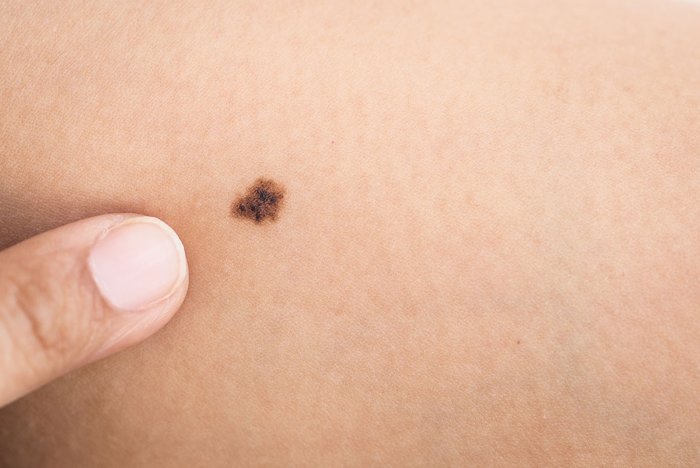 Here s How To Check If Your Mole Is Cancerous Health The Jakarta Post