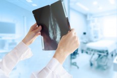 No need for chemo in many breast and lung cancers, major studies show