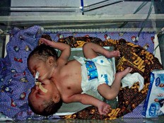  Baby with two heads receiving intensive treatment in West Nusa Tenggara