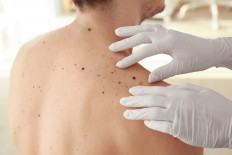Melanoma patients who remove lymph nodes don't live longer: study