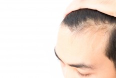 Five ways to help prevent hair loss in men