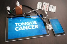 Five signs of tongue cancer to watch out for