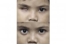 Before and after: Besta, four, was fitted with an artificial eye. JP/ Ben Latuihamallo