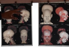 Indian surgeons remove 'heaviest recorded' brain tumor