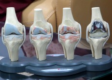 Knee injuries could take months to heal, with the ideal period to get back to normal being around nine months to a year, depending on the condition of each patient.