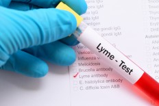 Blood sample for Lyme disease testing.