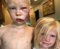 Bridger Walker, who lives in the western US state of Wyoming, put himself between a German Shepherd mix and his little sister on July 9 as the dog was about to attack the four-year-old girl.