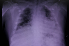 An X-ray of a COVID-19 patient's lungs at United Memorial Medical Center in Houston, Texas, United States, on July 10, 2020.  