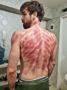 Not a tattoo: American Joe Coffey, 34, who lives in Bali, shows off his 'kerokan' marks. (Courtesy of Joe Coffey)