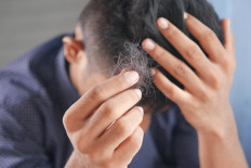 Indonesian dermatologists to research cure for balding and acne problems