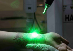 A woman gets tattoo removed with a laser during the event held by BAZNAS which provides a free tattoo removal program during the holy month of Ramadan at the Central Jakarta Mayor's Office in Jakarta, March 26, 2024. 