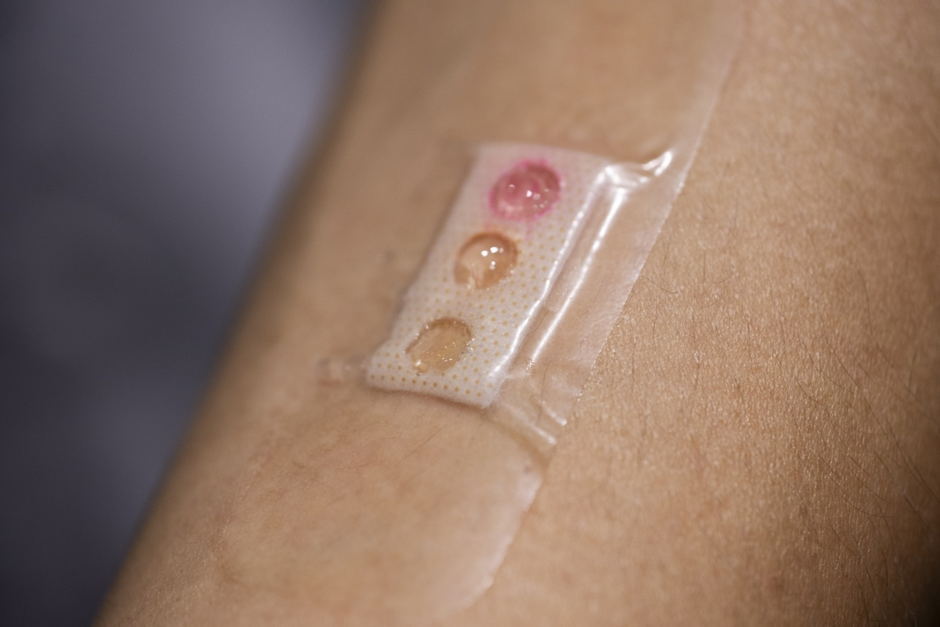 ‘Smart plaster’ may help measuring blood sugar without finger pricks: Study – Asia & Pacific – The Jakarta Post