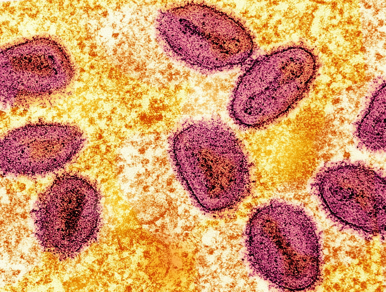 First Case of Clade I Mpox Confirmed in Canada: Public Health Alert Issued